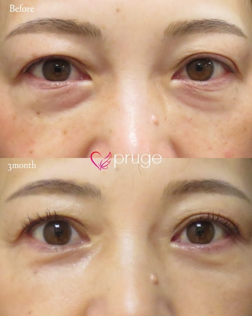 【PRP-MI脱脂術・PRP注射（目頭）】