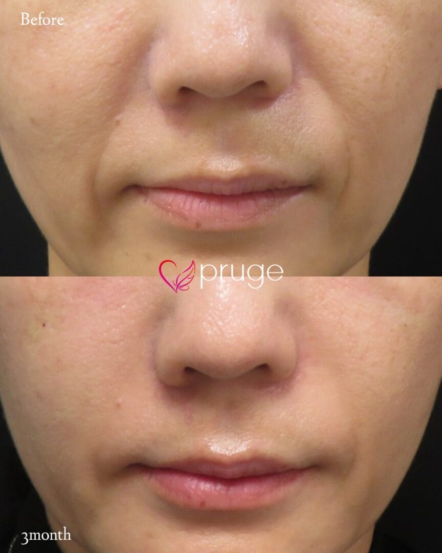 PRP注射（法令線）