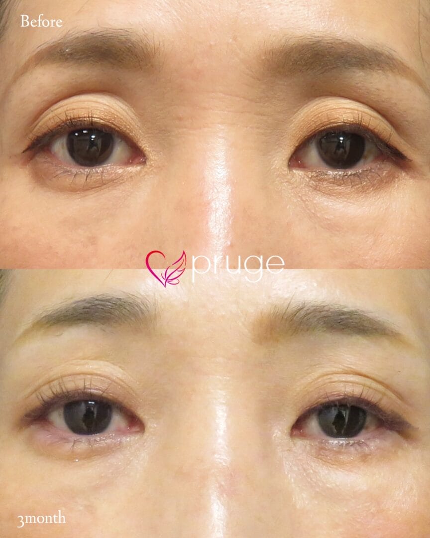 PRP注射(目の上)