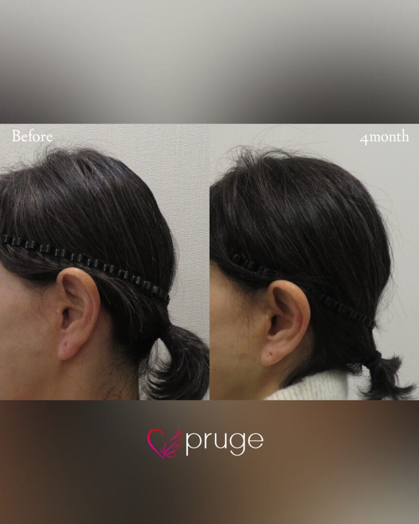 PRP注射(後頭部形成術)