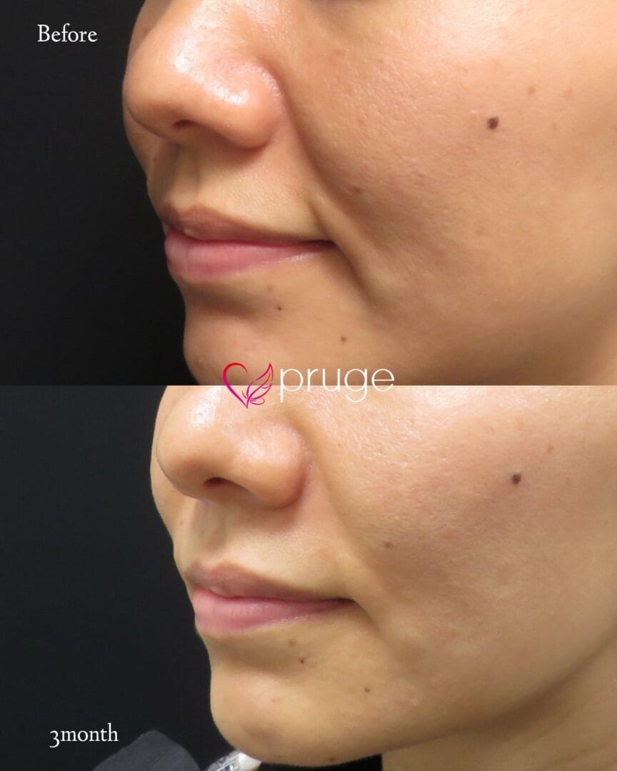 PRP注射(法令線)