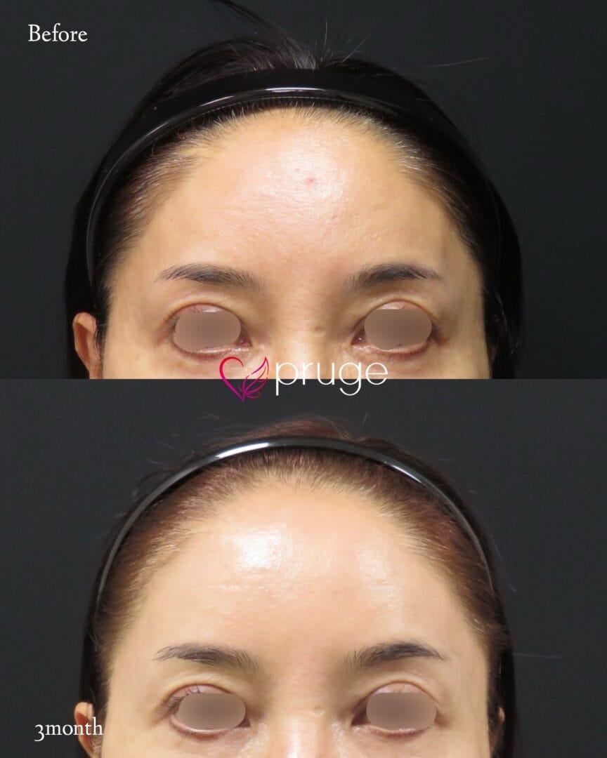 PRP注射（こめかみ凹み）