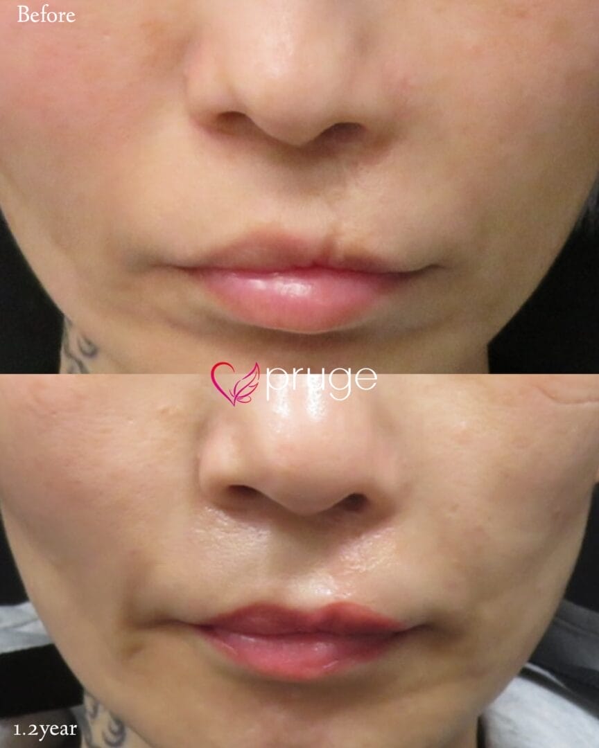 口蓋裂術後変形に対する左人中陵へのPRP注射