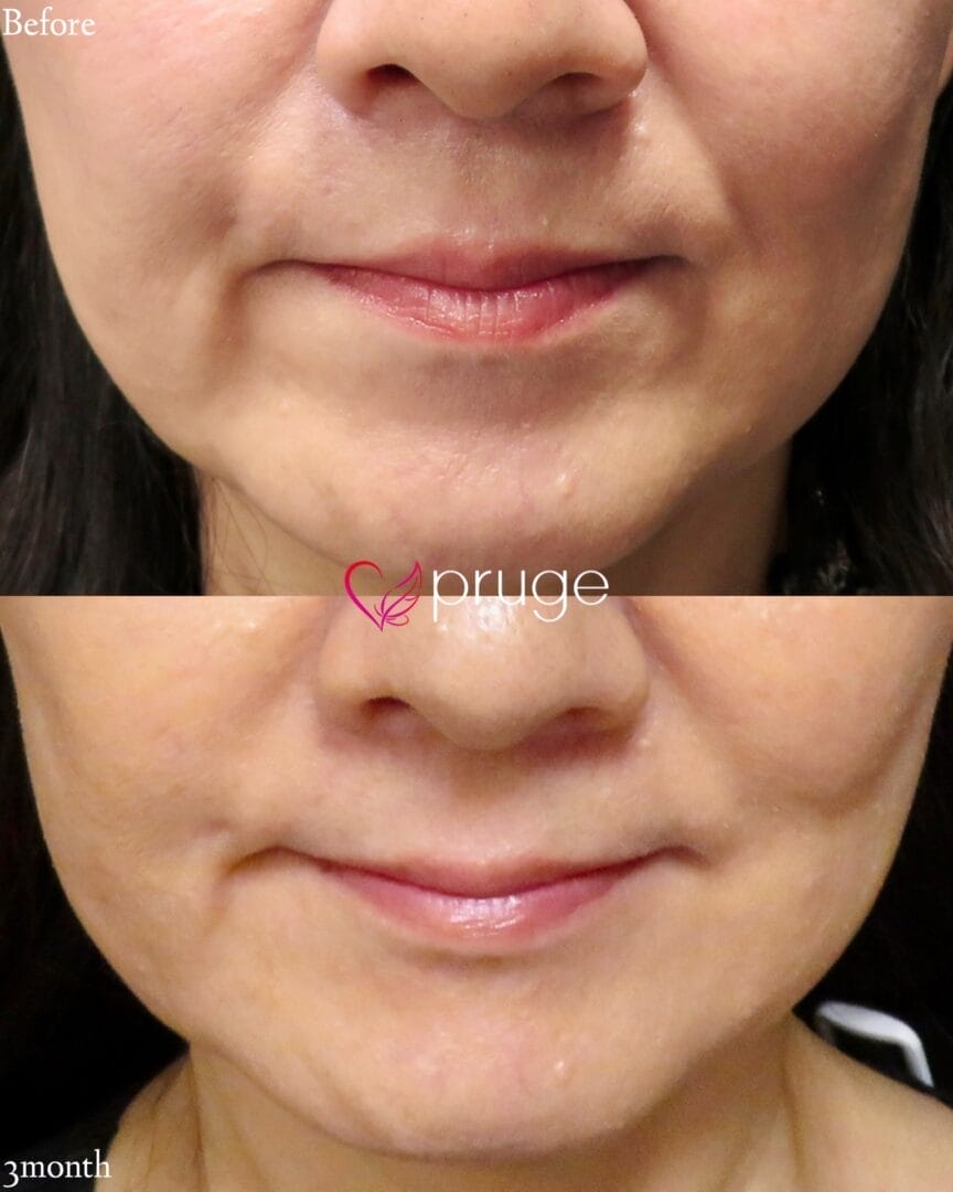 PRP注射（マリオネットライン）