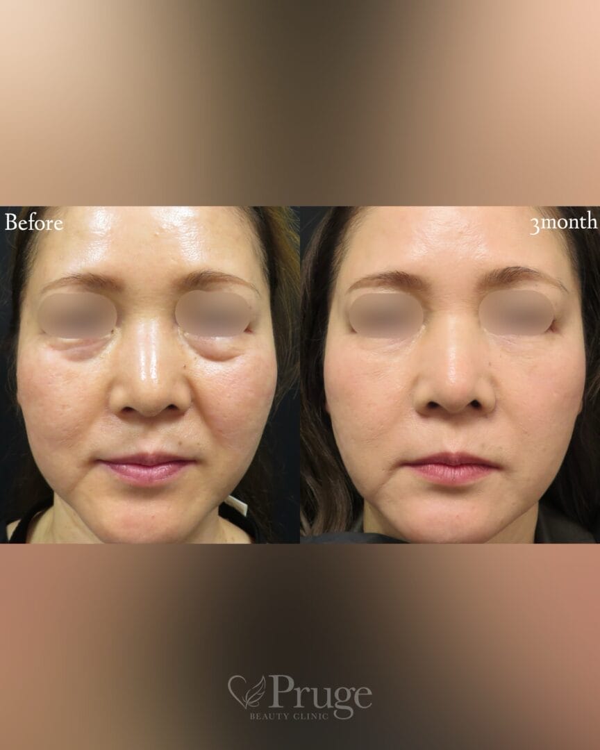 PRP注射(目の下・法令線)