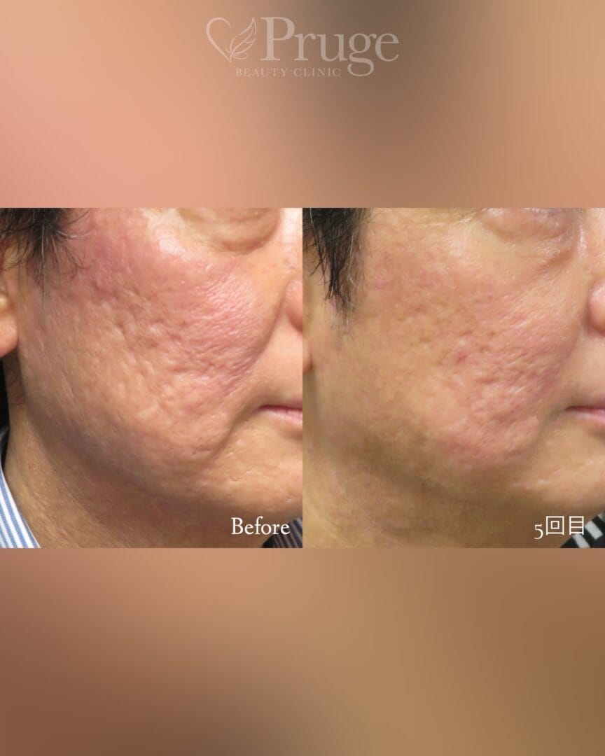 PRPサブシジジョン法(ホホ)