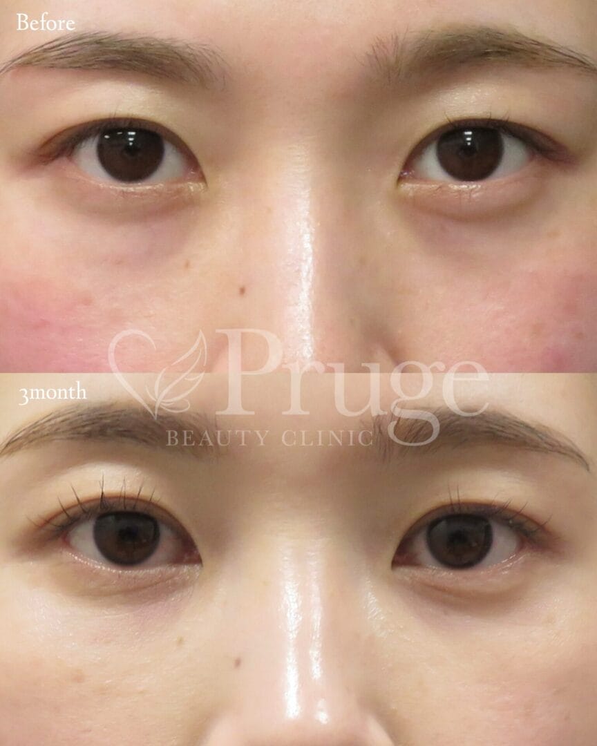 PRP注射(目の下・ゴルゴライン)