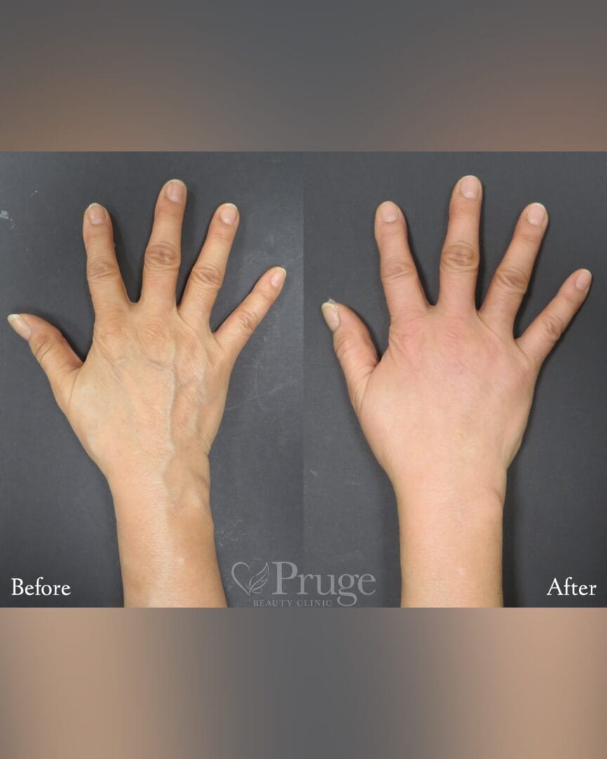 PRP注射(手の甲)・硬化療法