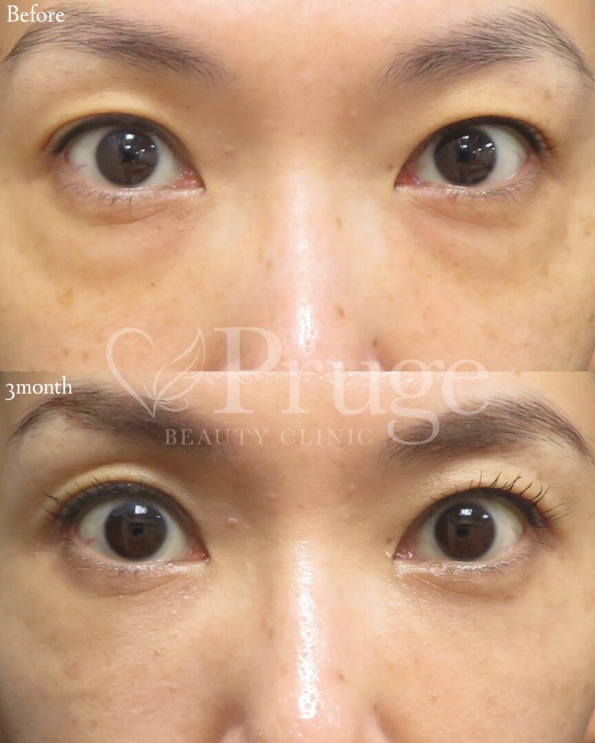 PRP-MI脱脂術(目の下)