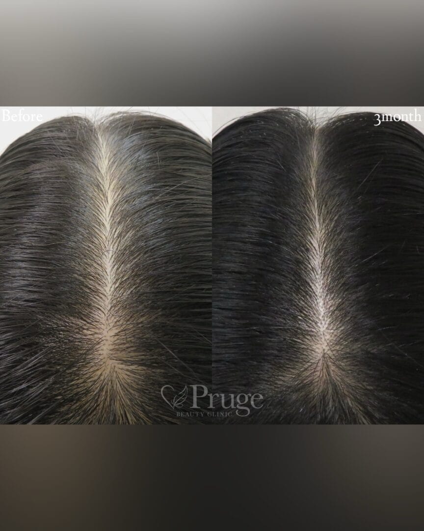 p-Scalp