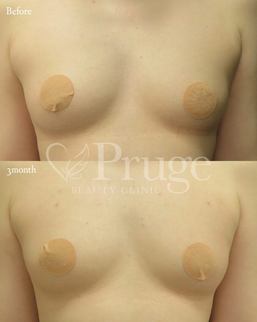 PRP注射によるバストアップ