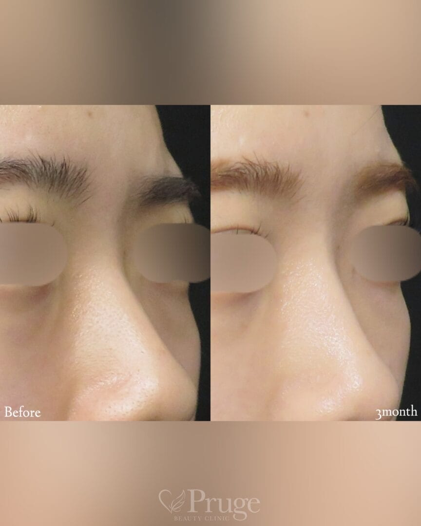 PRP注射(鼻根)