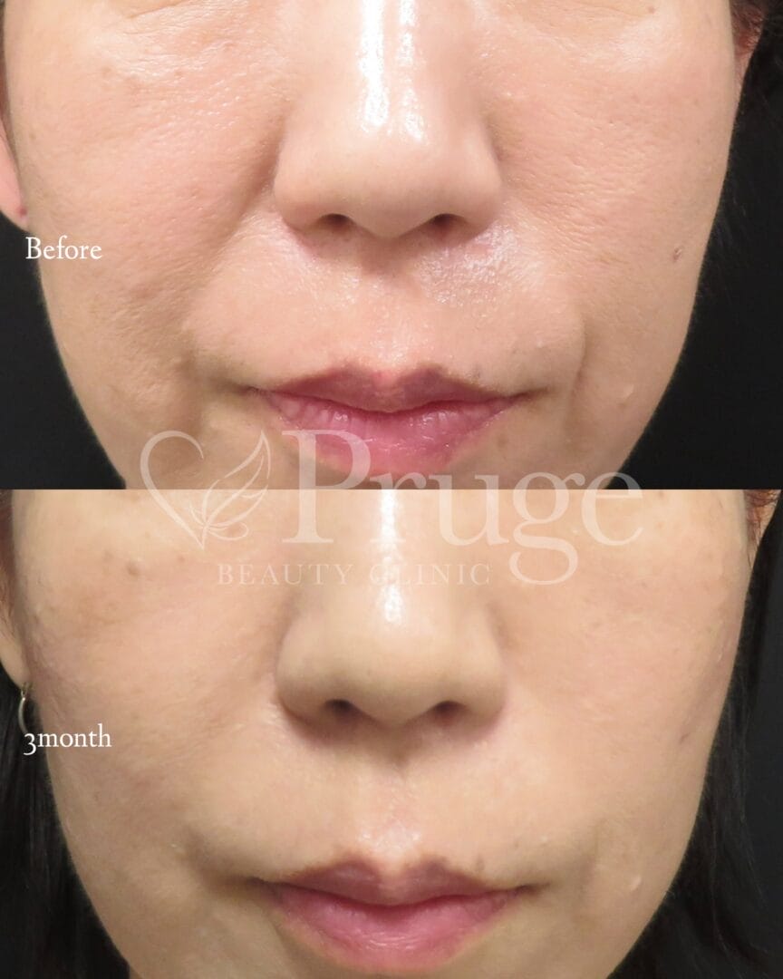 PRP注射(法令線)