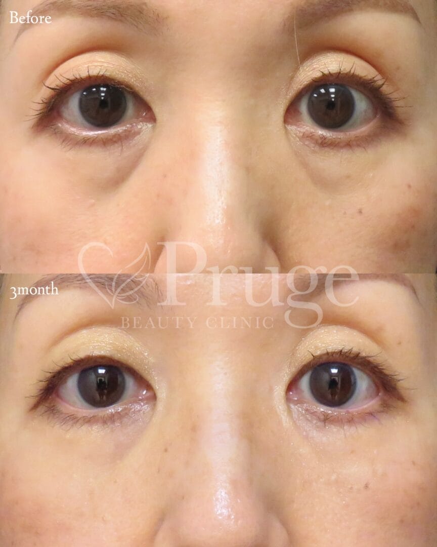 PRP注射(目の下)