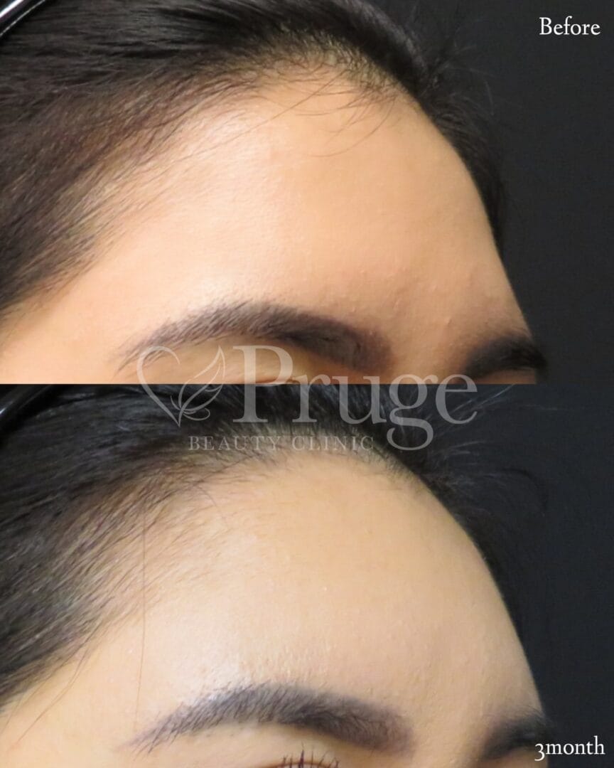 PRP注射(ひたい・こめかみ丸み形成)