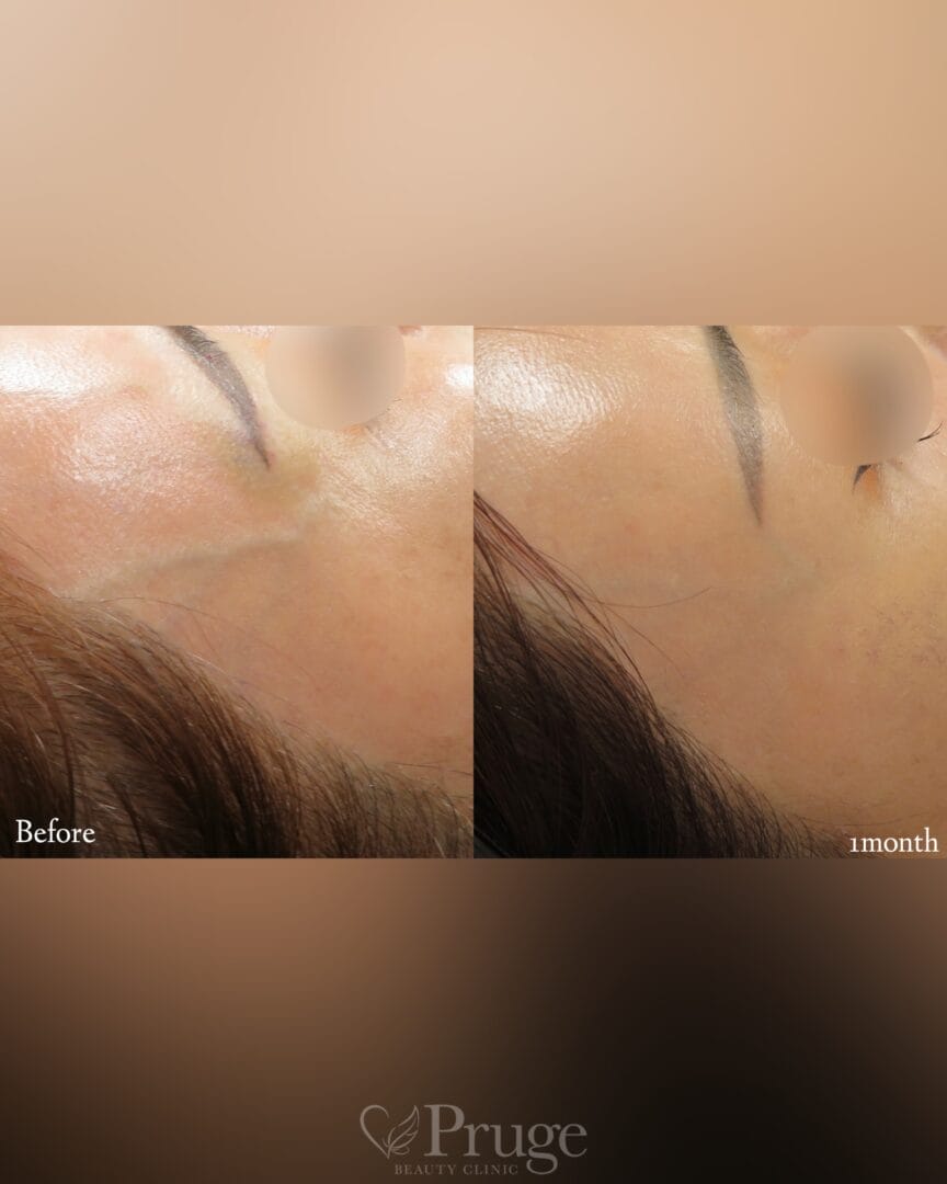 こめかみの血管に対するフェイススクレロセラピー