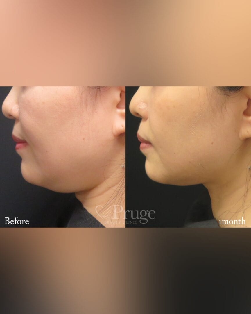 Pスリム注射（あご下）