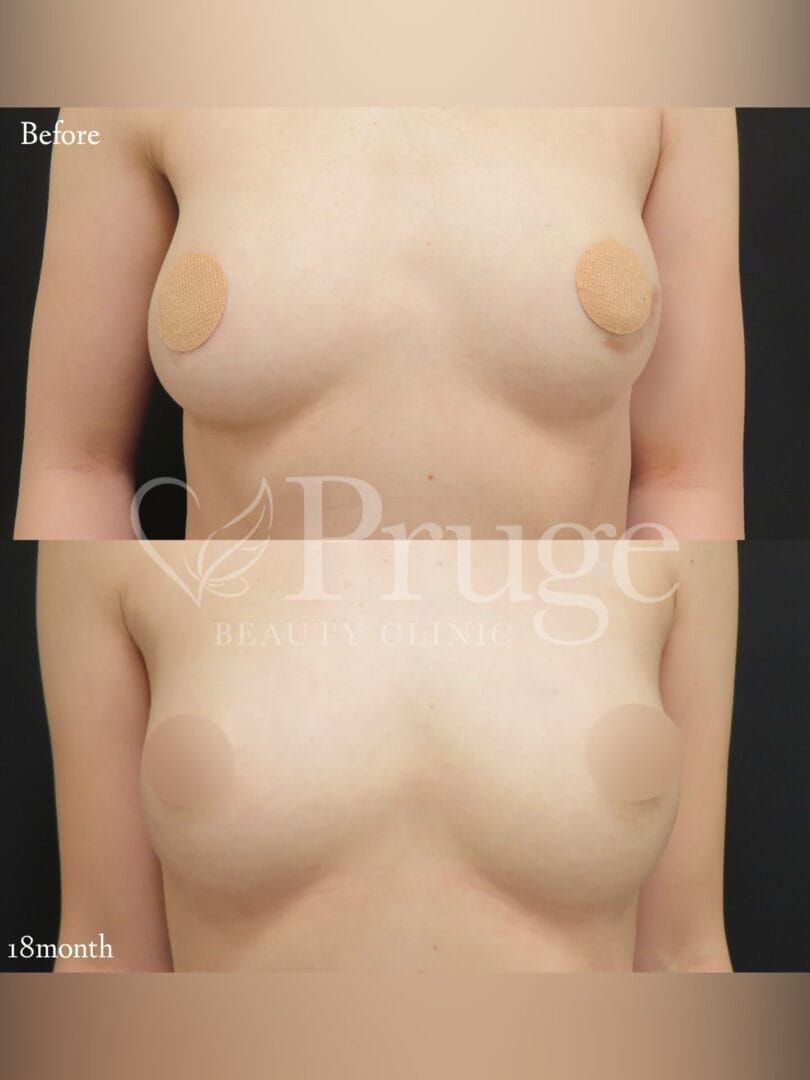 PRP注射によるバストアップ