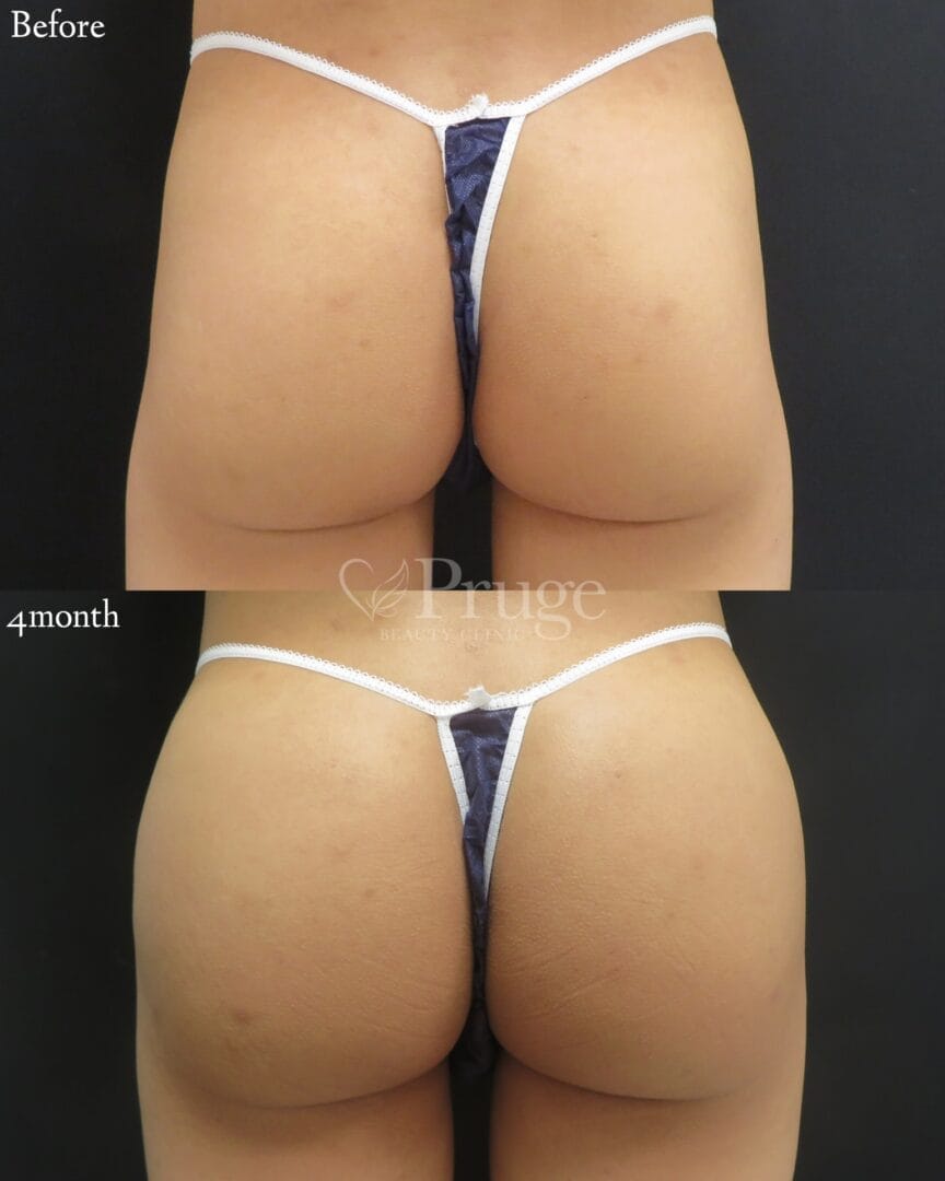 PRP注射によるヒップ形成（アイスプレミアム）