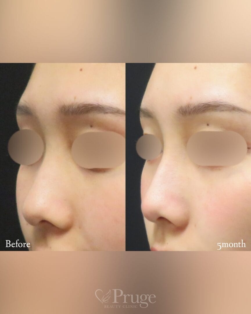 PRP注射（鼻根）