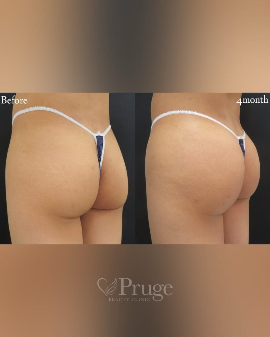 PRP注射によるヒップ形成（アイスプレミアム）