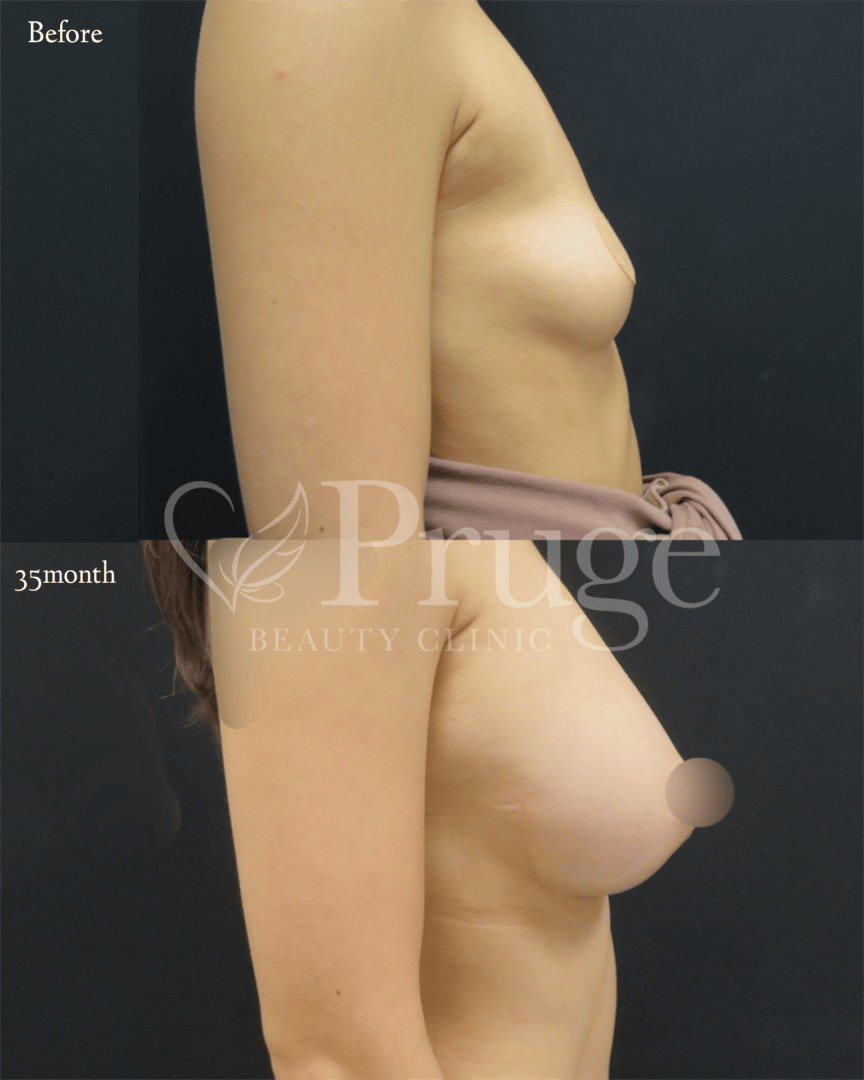 PRP注射によるバストアップ(アイスプレミアム)