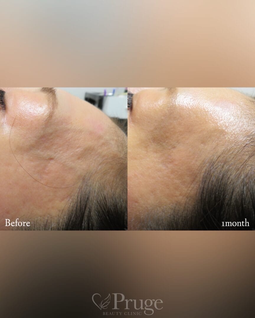 こめかみの血管に対するフェイススクレロセラピー