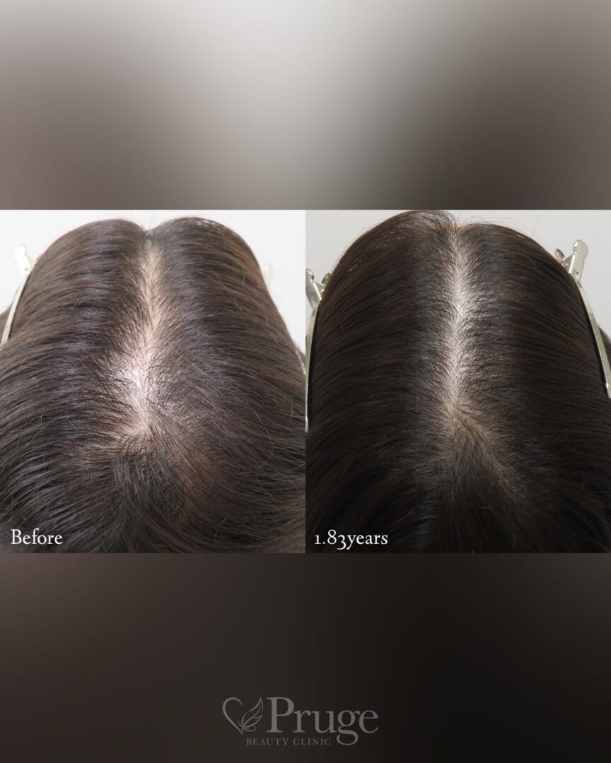 p-Scalp