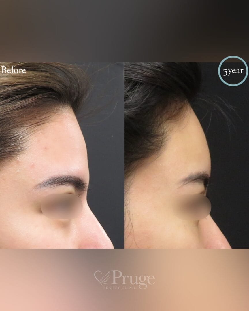 PRP注射(ひたい・こめかみ丸み形成)