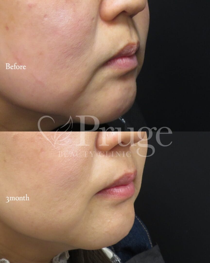 PRP注射(マリオネットライン)