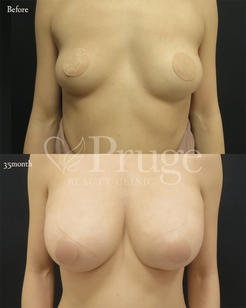 PRP注射によるバストアップ(アイスプレミアム)