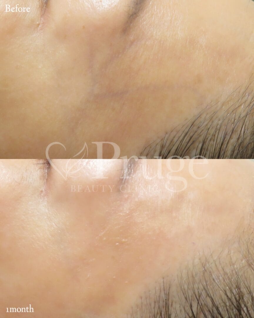 こめかみの血管に対するフェイススクレロセラピー