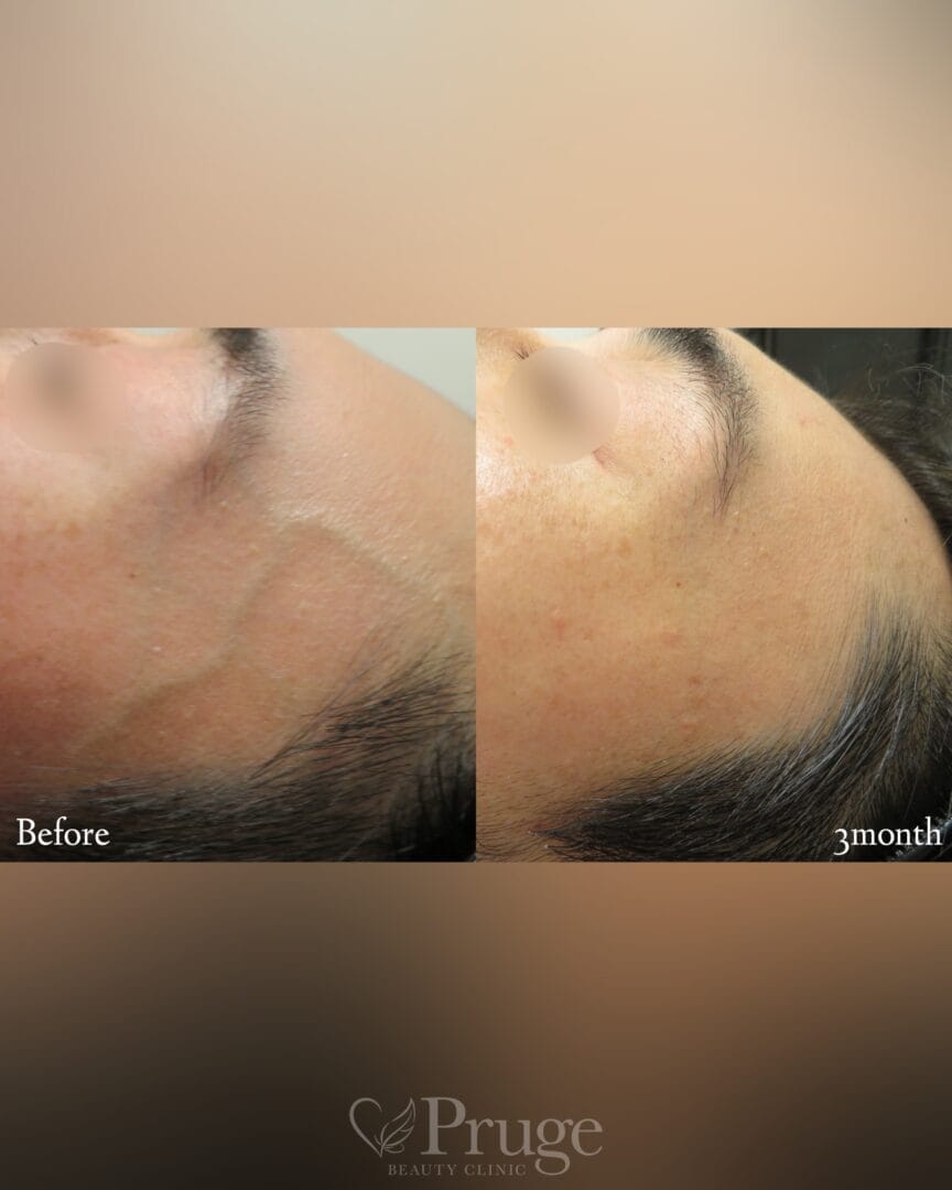 こめかみの血管に対するフェイススクレロセラピー