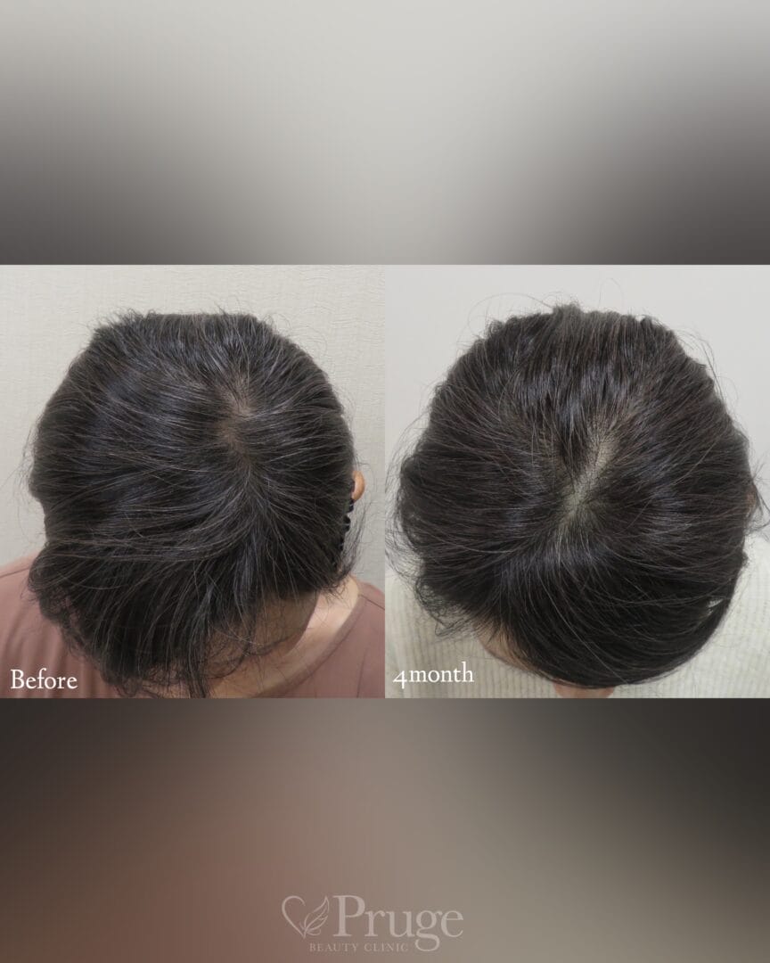 PRP注射(後頭部形成術)