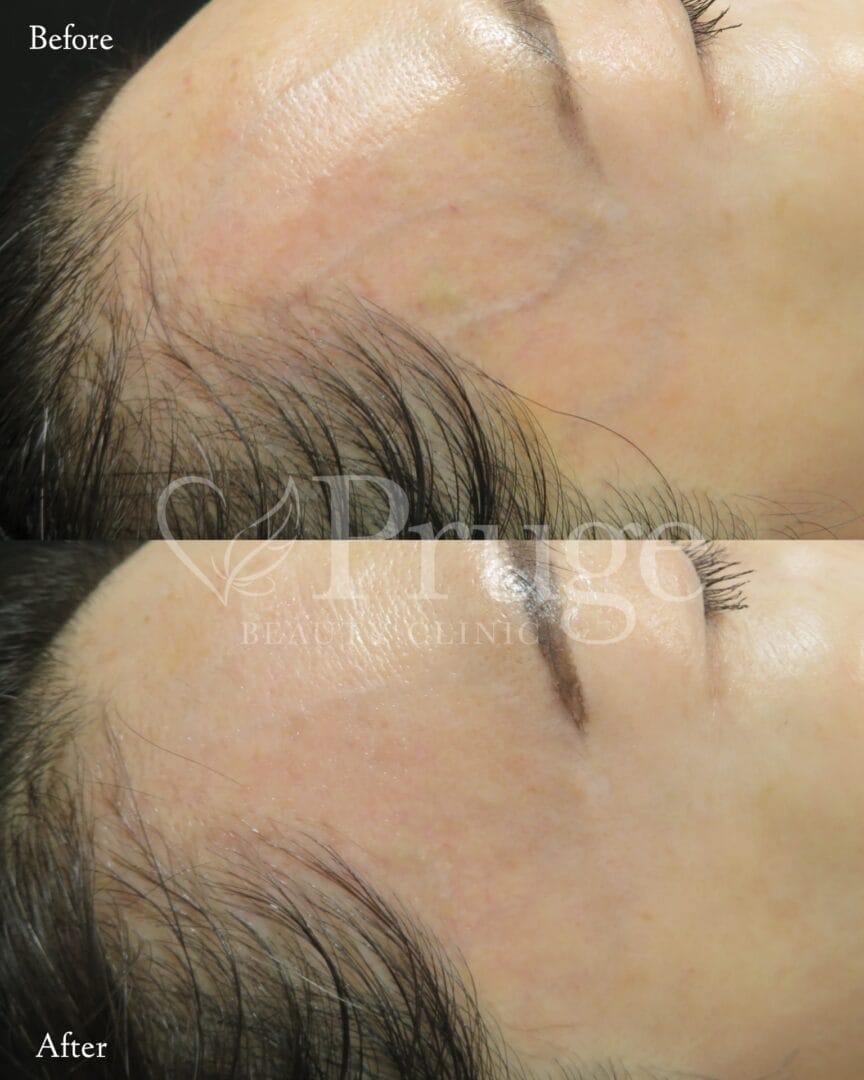 こめかみの血管に対するフェイススクレロセラピー