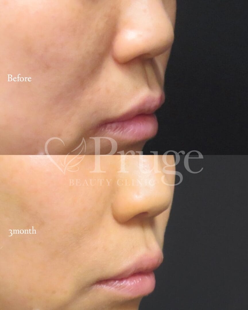 PRP注射(ほうれい線)