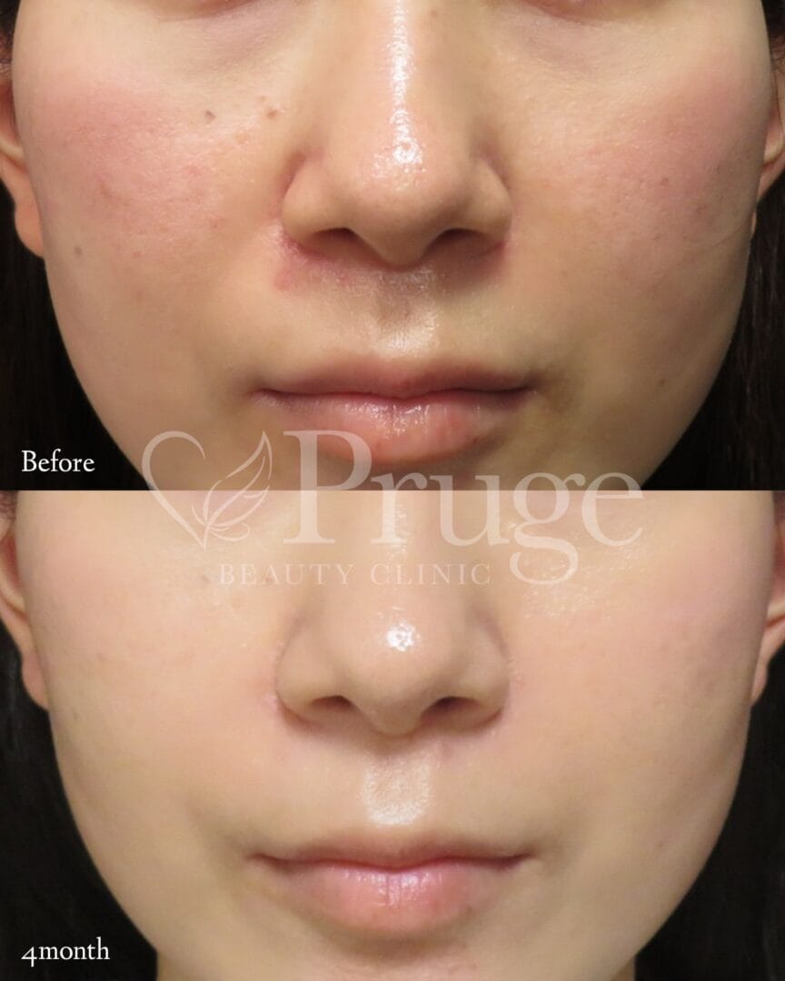 PRP注射(鼻翼基部)