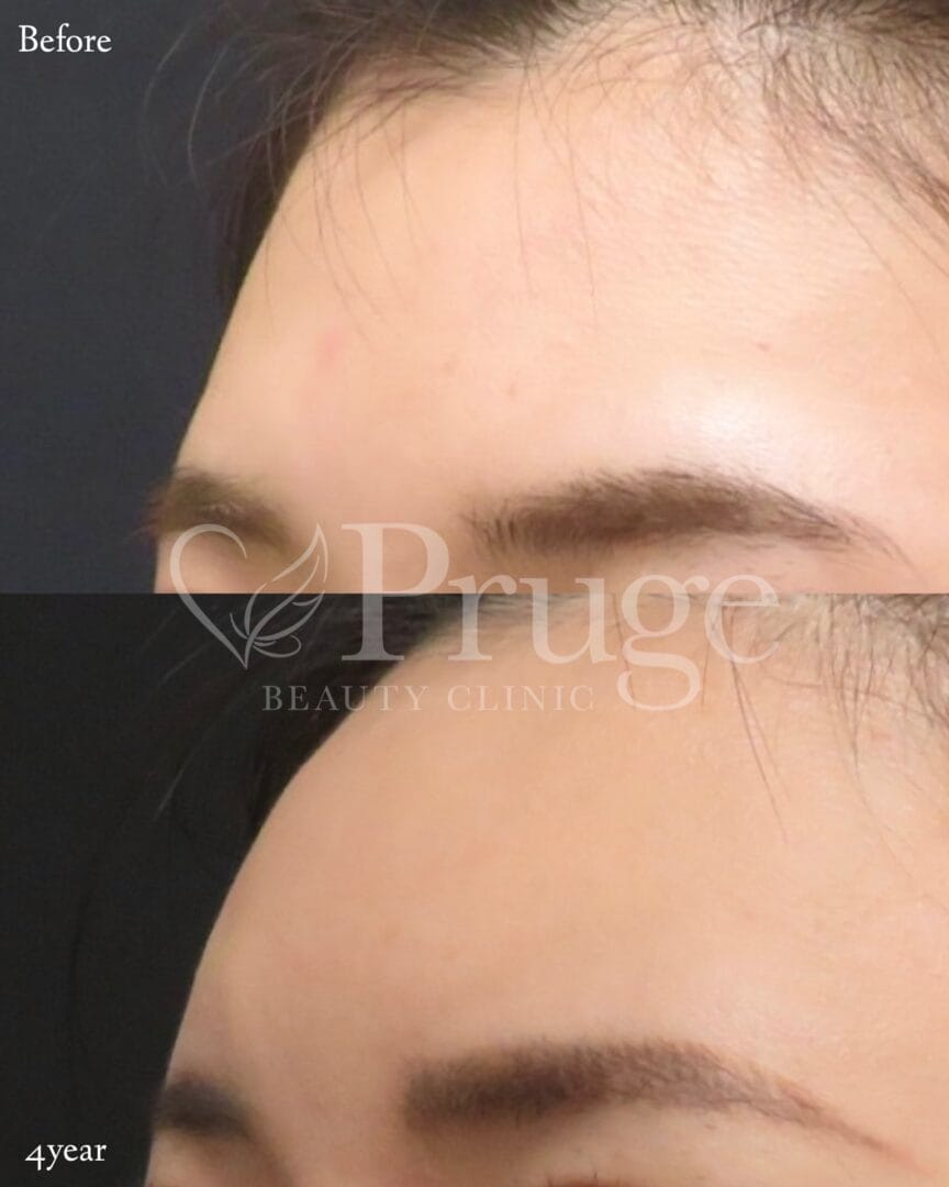 PRP注射(ひたい・こめかみ丸み形成)