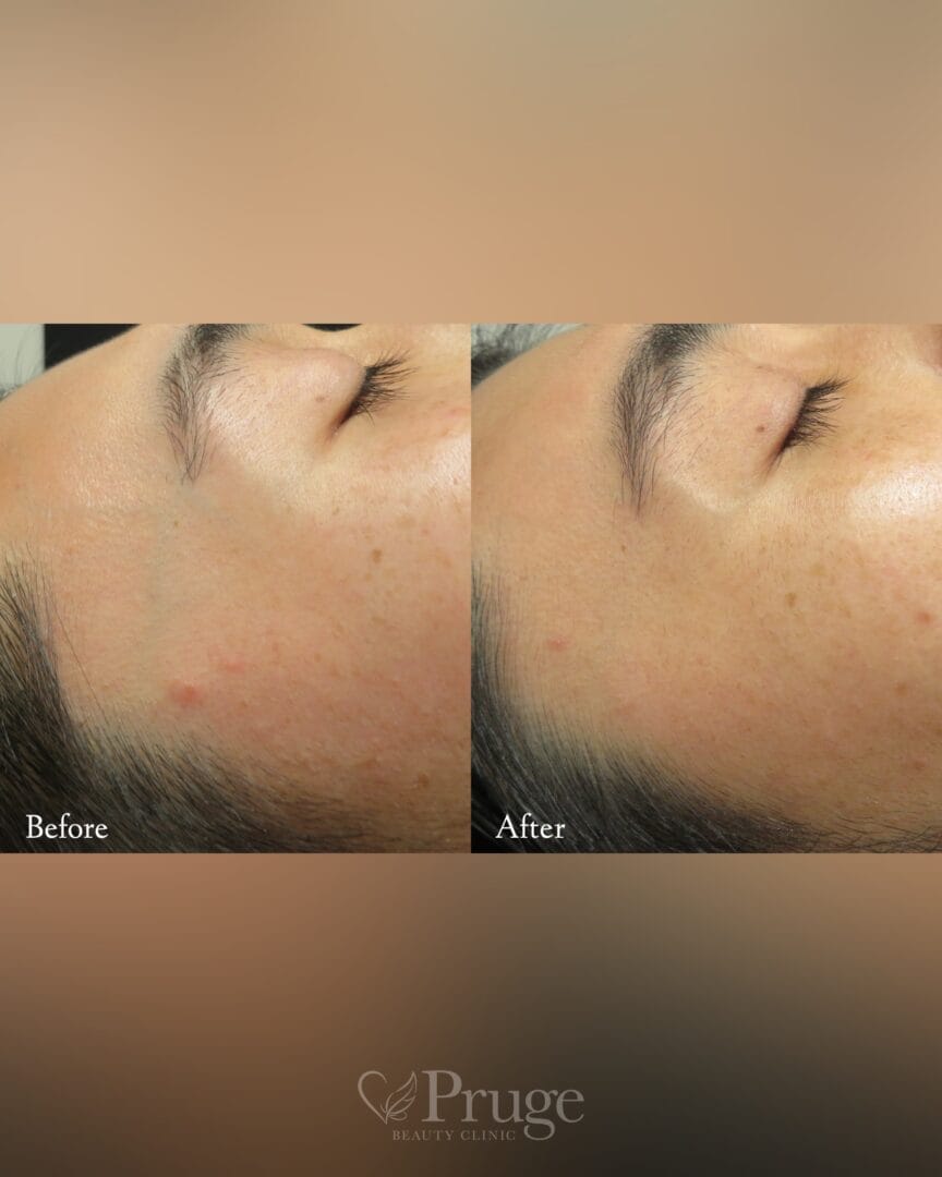 こめかみの血管に対するフェイススクレロセラピーの症例写真