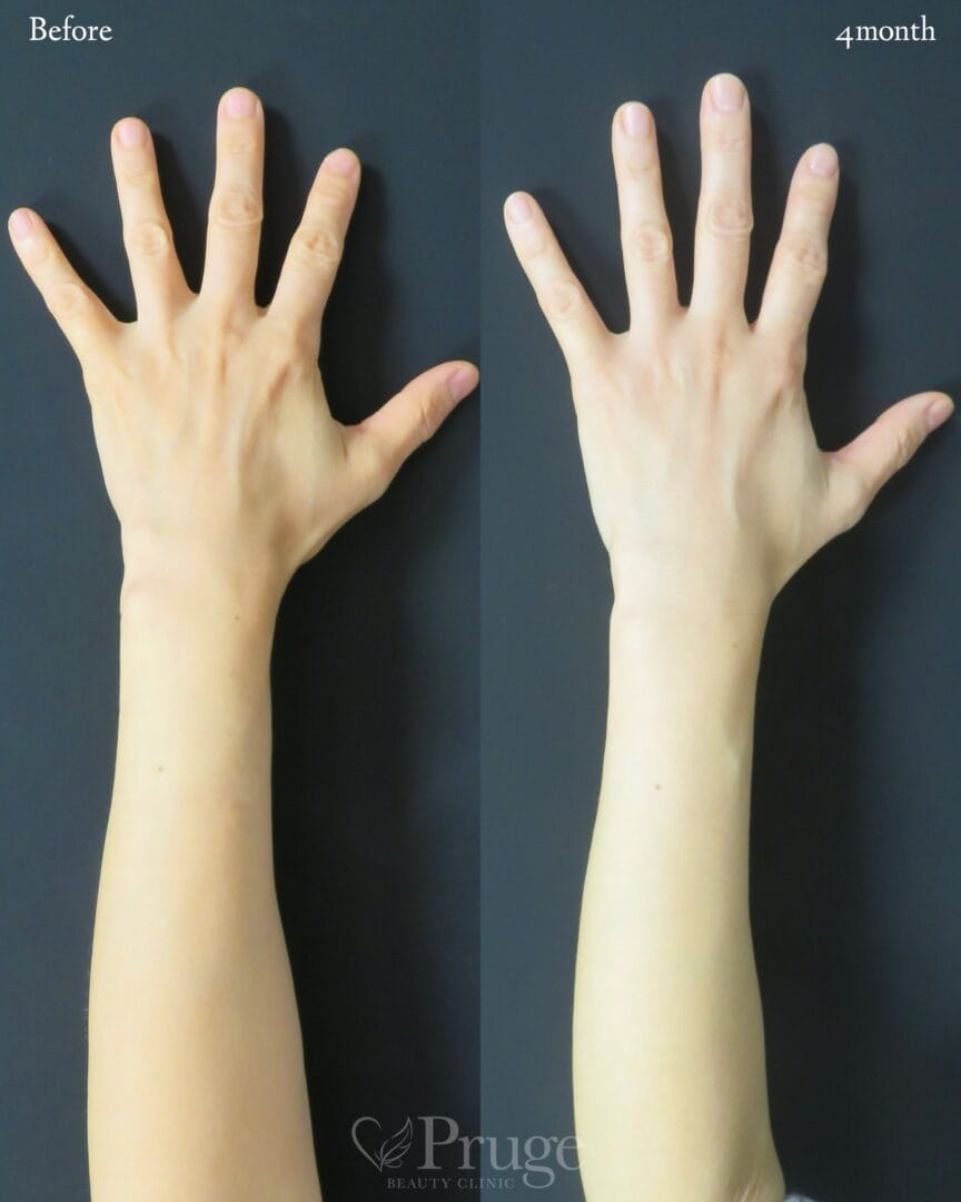 PRP注射(手の甲・腕)