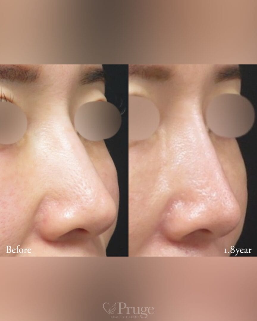 PRP注射（鼻根・鼻尖）