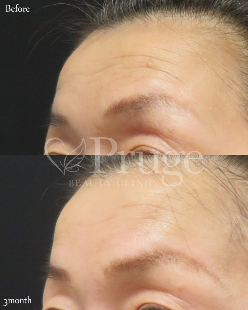PRP注射(額のシワ)の症例写真