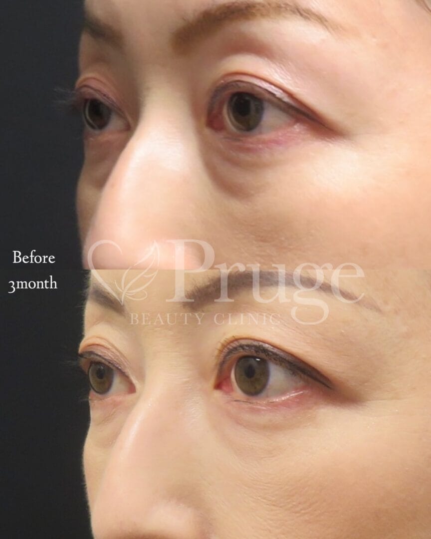 PRP注射(目の下)の症例写真