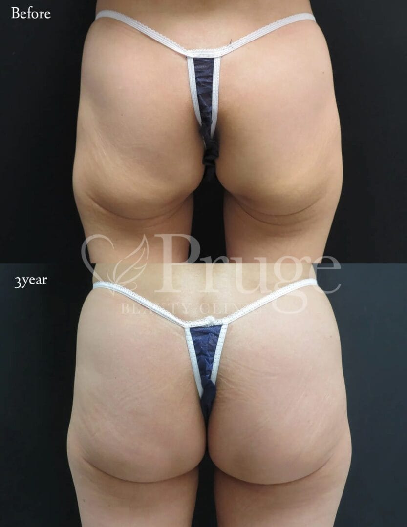 PRP注射によるヒップ形成の症例写真