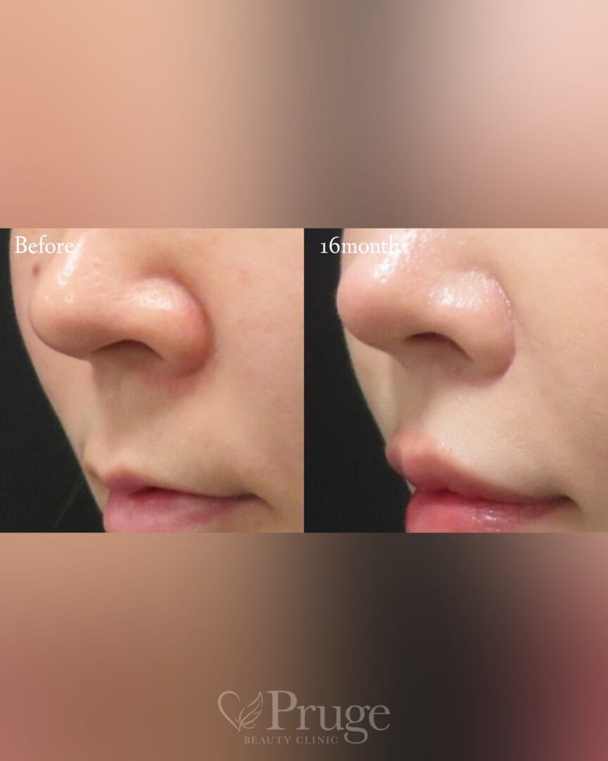 PRP注射（鼻唇角）の症例写真