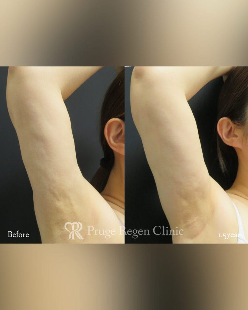 しぼう吸引後修正(二の腕)の症例写真